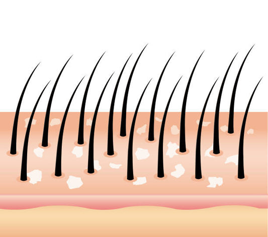 Dealing with Flaky Scalp: Causes and Solutions